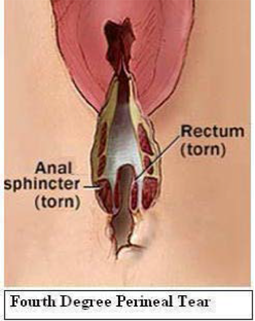 Fourth degree perineal tear