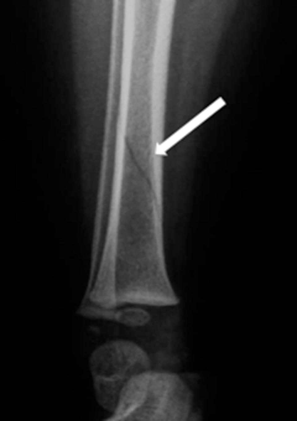 Fractured bone scan