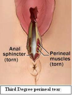 Third degree perineal tear